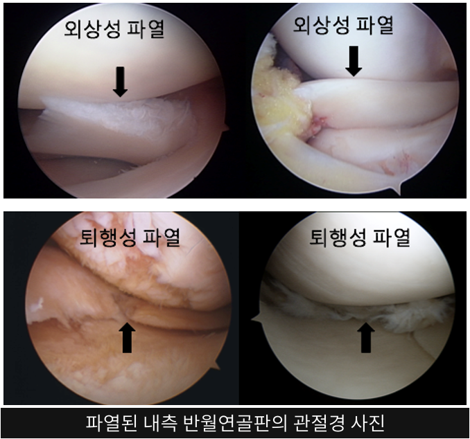 파열된 내측 반월연골판의 관절경 사진 (위: 외상성 파열, 아래: 퇴행성 파열