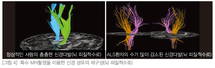그림 3_특수 MRI촬영을 이용한 신경 섬유의 재구성(뇌 피질척수로)